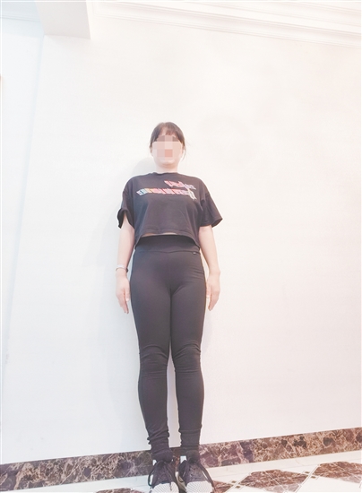 高女士减脂前后对比。 高女士减脂前后对比。