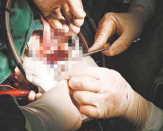 多学科协作完成手术。 多学科协作完成手术。